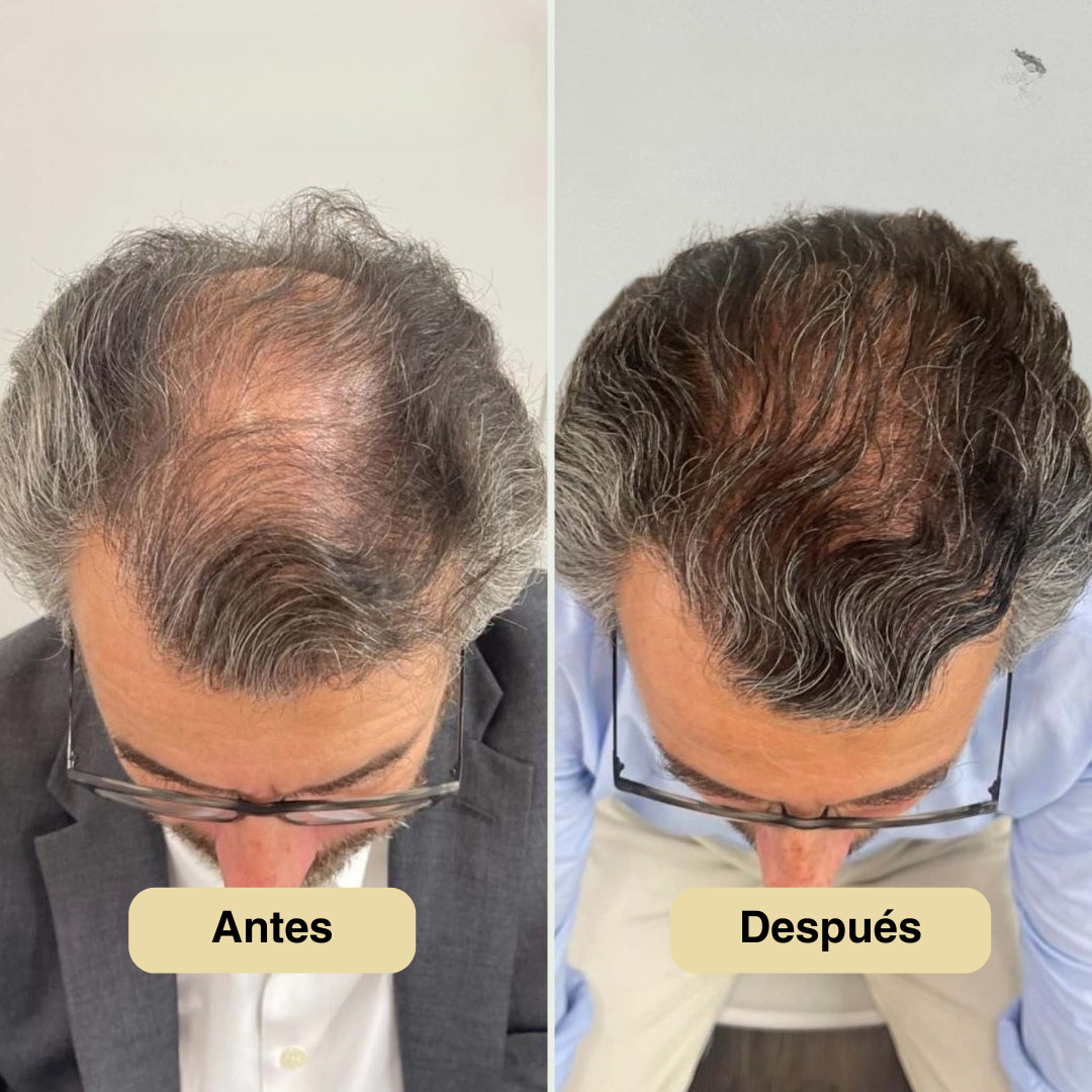 Roll-On Para El Crecimiento Del Cabello