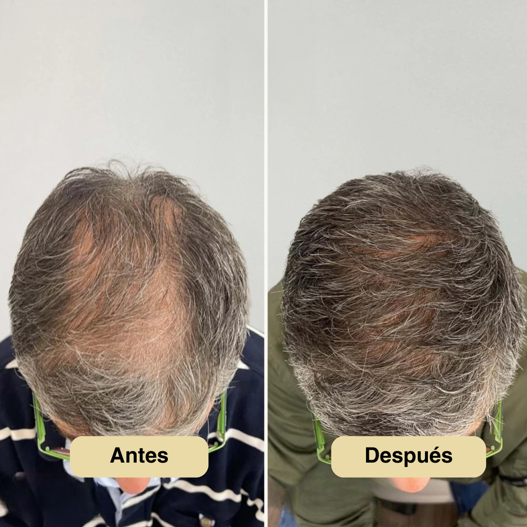 Roll-On Para El Crecimiento Del Cabello